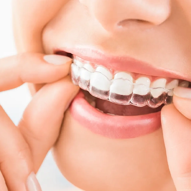 Invisalign-image