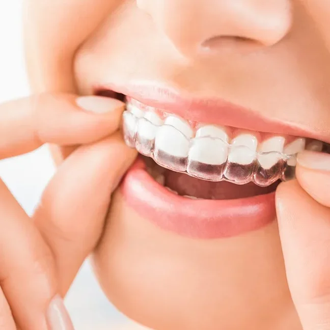 aligner therapy img - Gardens Dentistry Palm Beach
