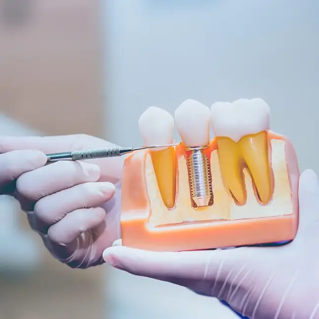 Dental Implants Img