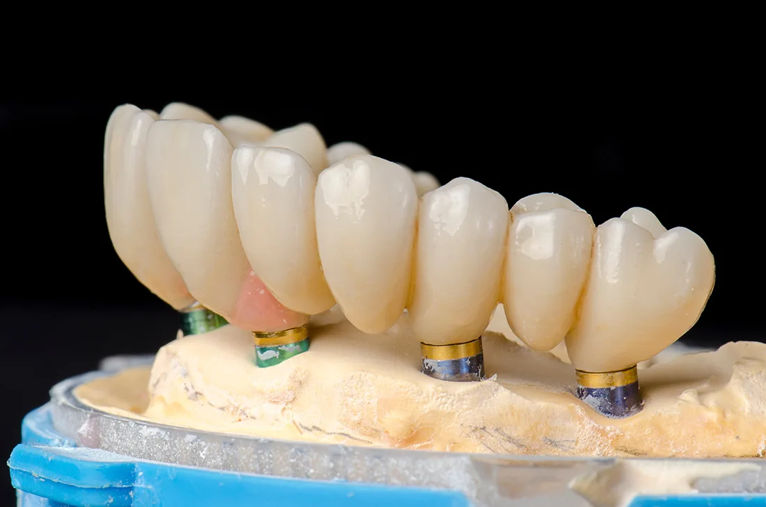 Service Thumbnail All Implants
