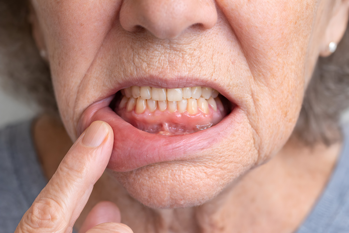 Older Woman Showing Gum Irritation and Oral Health Problem