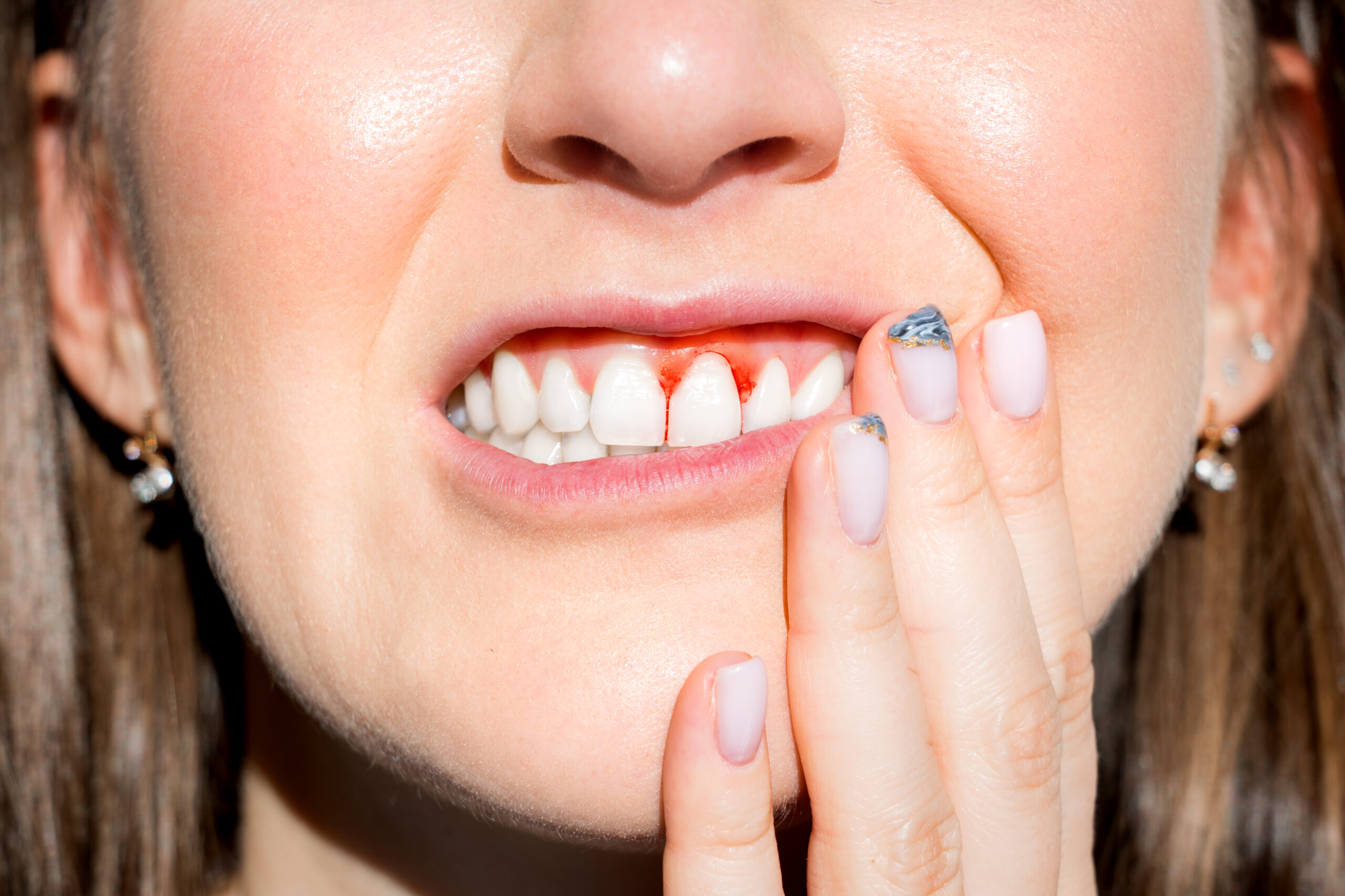 Woman filling pain because of bleeding gums. Periodontal disease, avitaminosis, gingivitis, scurvy. High quality photo